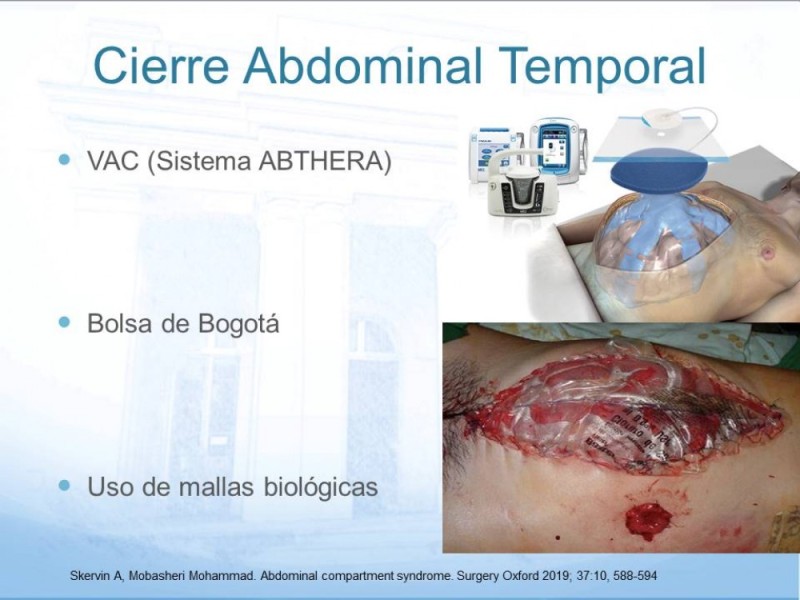Diapositiva 15 de Síndrome Compartimental Abdominal