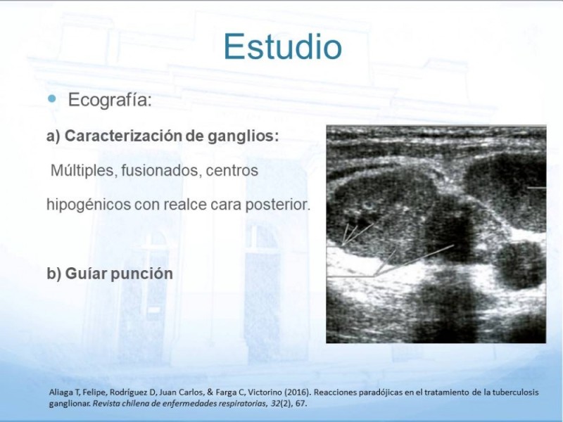 Diapositiva 5 de Tuberculosis Ganglionar