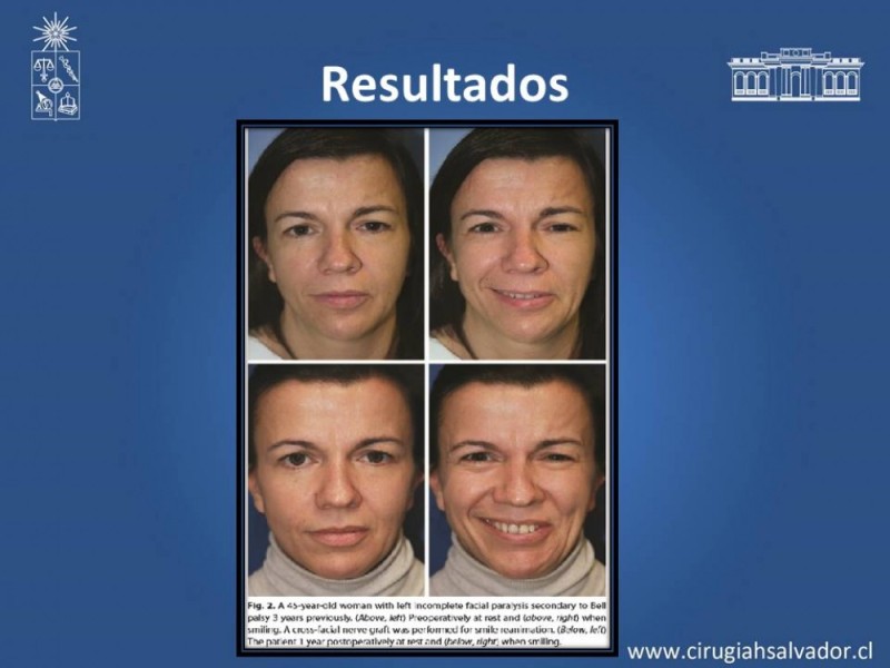 Diapositiva 15 de Injerto Nervioso facial vs transposición Nervio Masetérico