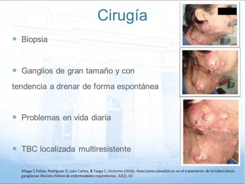 Diapositiva 12 de Tuberculosis Ganglionar