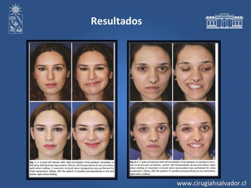 Diapositiva 20 de Injerto Nervioso facial vs transposición Nervio Masetérico
