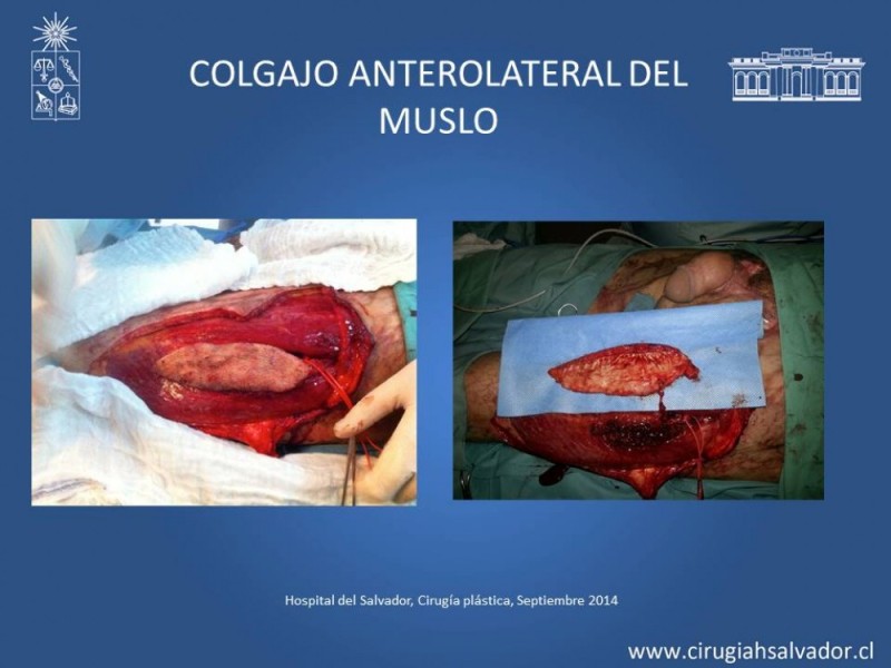 Diapositiva 35 de Aplicación Colgajos Perforantes