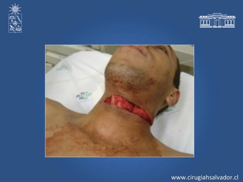 Diapositiva 49 de Trauma Carotídeo