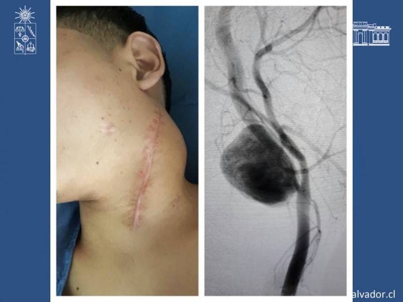 Diapositiva 22 de Trauma Carotídeo