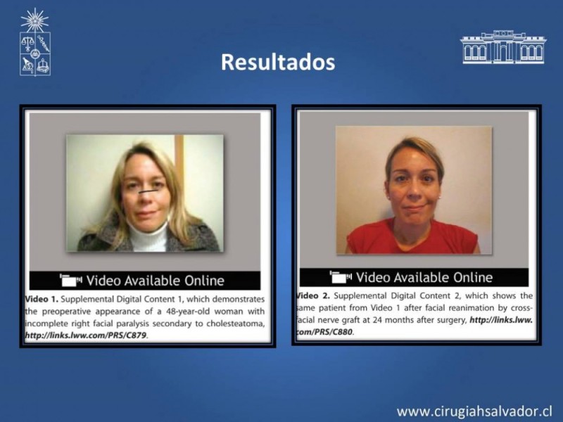 Diapositiva 16 de Injerto Nervioso facial vs transposición Nervio Masetérico