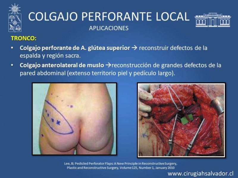 Diapositiva 30 de Aplicación Colgajos Perforantes