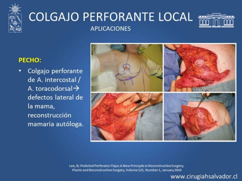 Diapositiva 26 de Aplicación Colgajos Perforantes