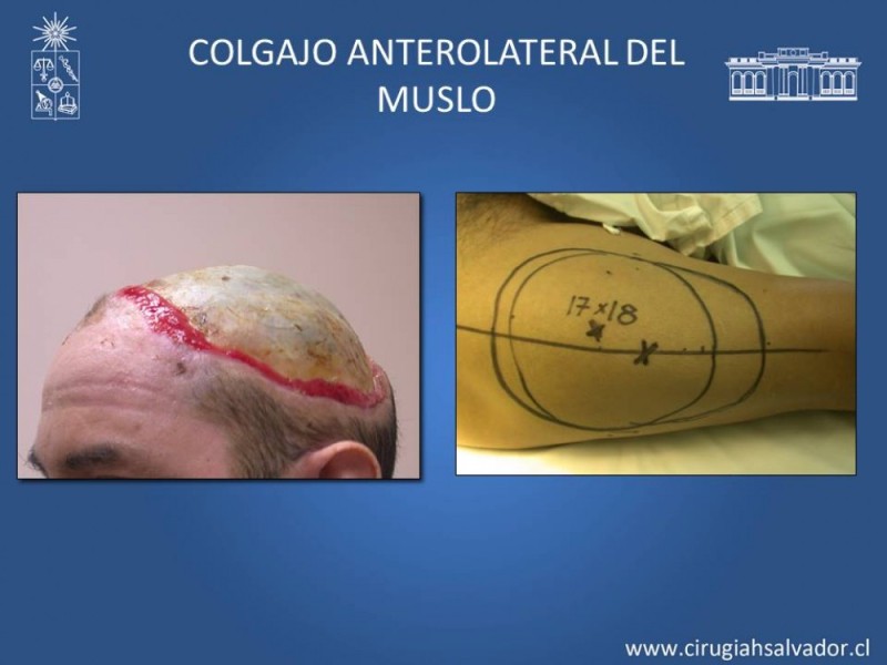 Diapositiva 40 de Aplicación Colgajos Perforantes