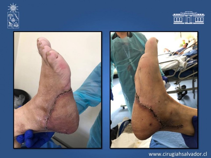 Diapositiva 57 de Aplicación Colgajos Perforantes