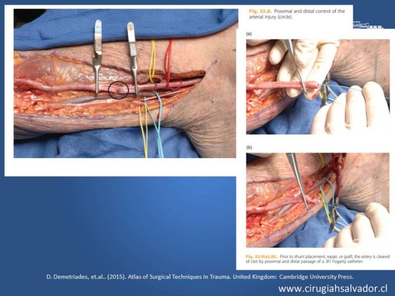 Diapositiva 28 de Trauma Vascular Periférico