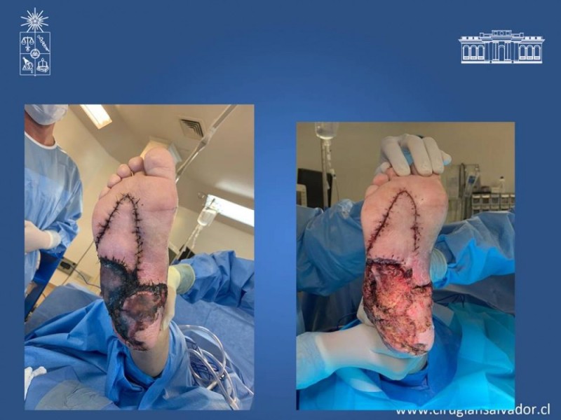 Diapositiva 48 de Aplicación Colgajos Perforantes