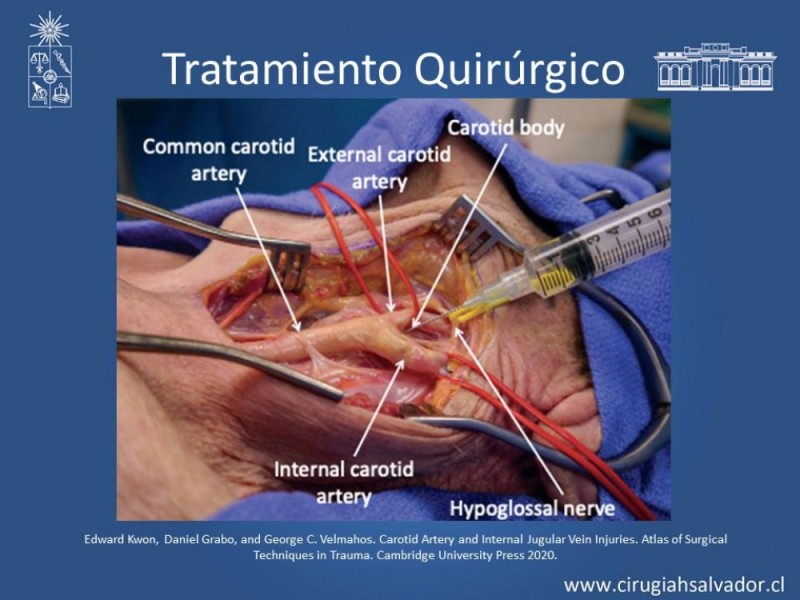 Diapositiva 36 de Trauma Carotídeo