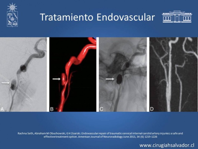 Diapositiva 25 de Trauma Carotídeo