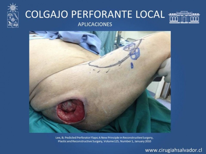 Diapositiva 37 de Aplicación Colgajos Perforantes