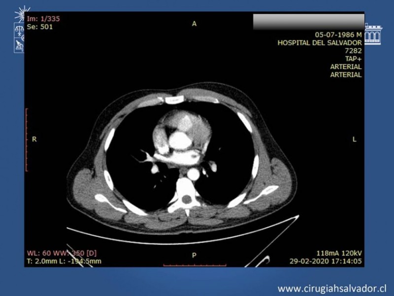 Diapositiva 22 de Trauma Esplénico