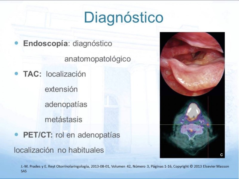 Diapositiva 10 de Cáncer Laringeo