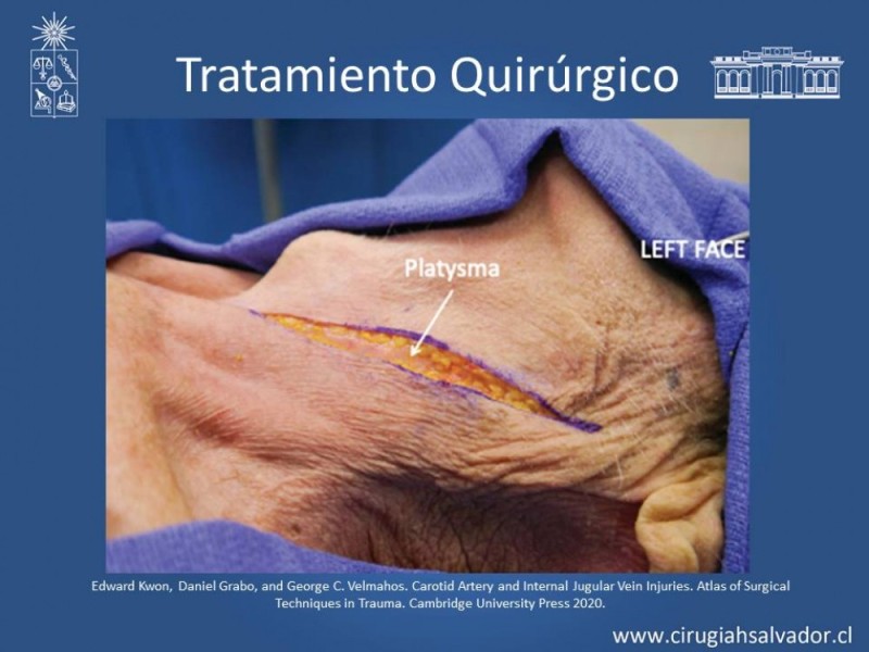 Diapositiva 32 de Trauma Carotídeo