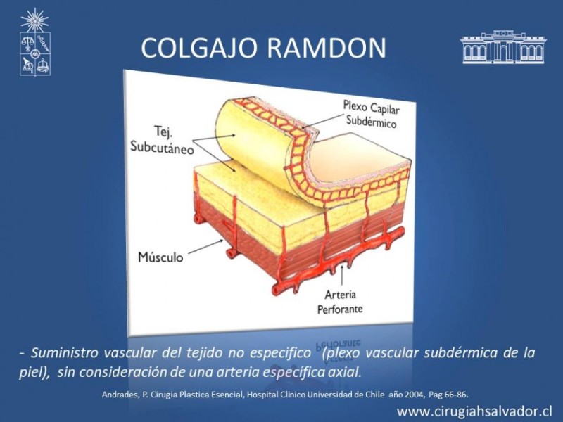 Diapositiva 7 de Aplicación Colgajos Perforantes
