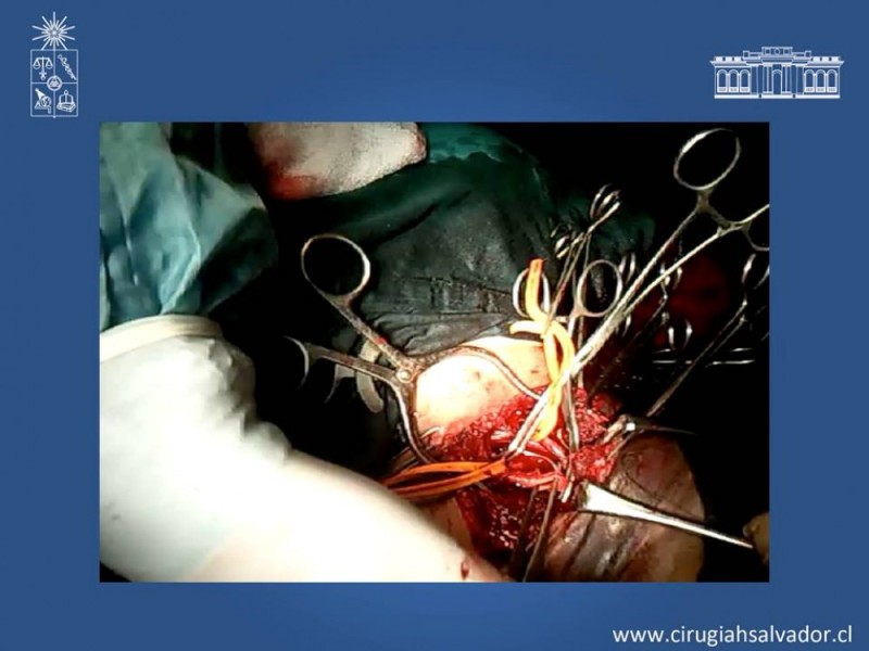 Diapositiva 30 de Trauma Carotídeo