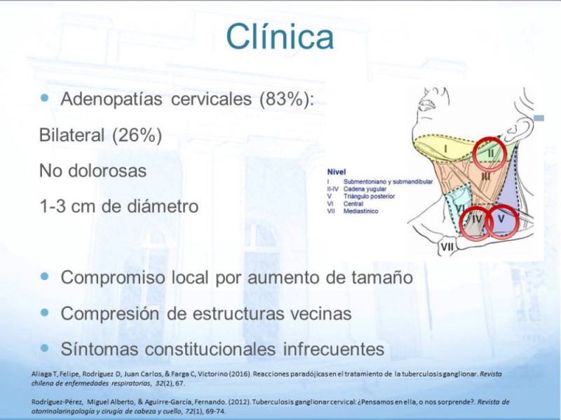 Diapositiva 4 de Tuberculosis Ganglionar