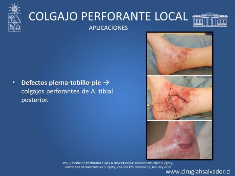 Diapositiva 44 de Aplicación Colgajos Perforantes