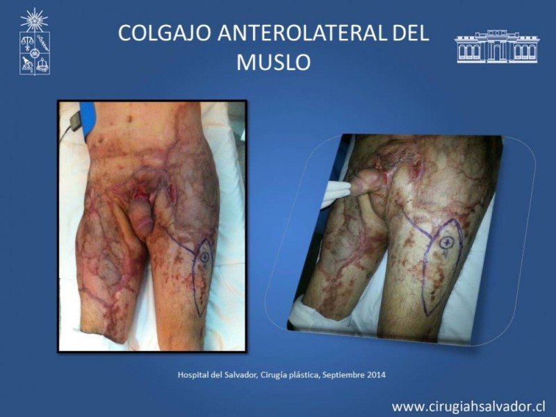 Diapositiva 34 de Aplicación Colgajos Perforantes