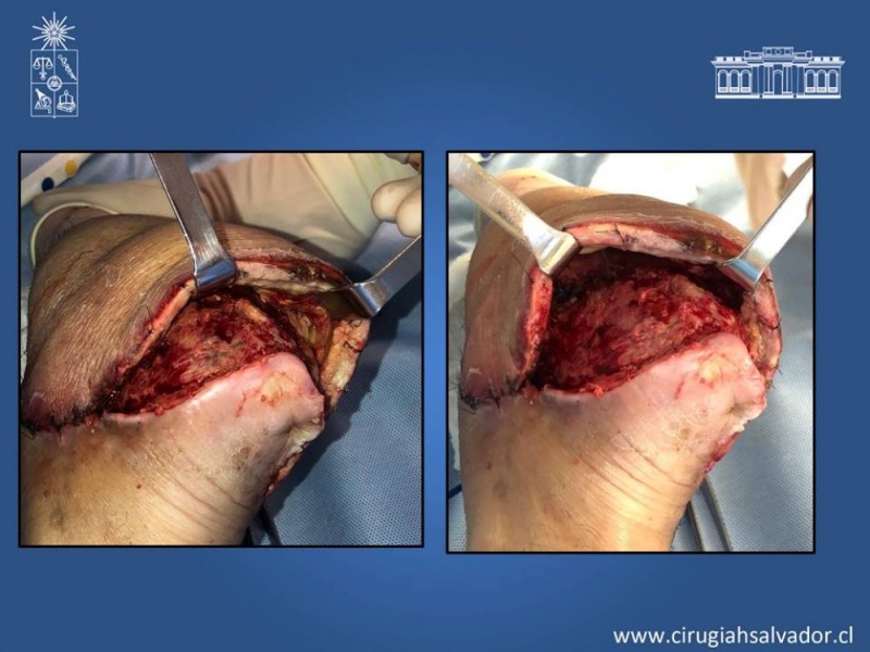 Diapositiva 55 de Aplicación Colgajos Perforantes