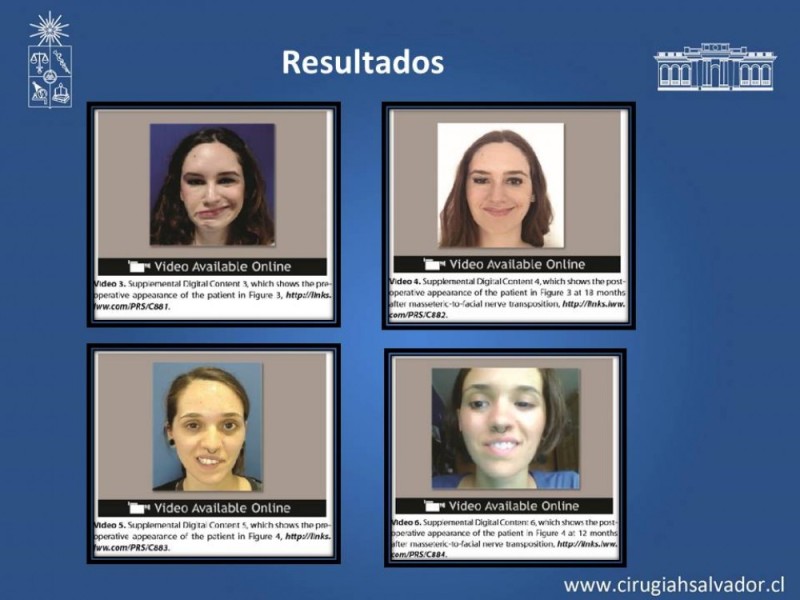 Diapositiva 21 de Injerto Nervioso facial vs transposición Nervio Masetérico