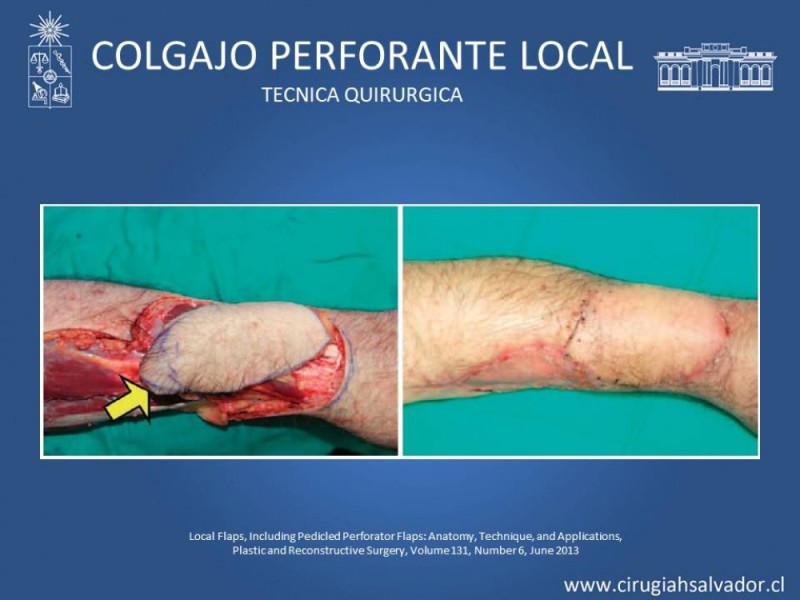 Diapositiva 17 de Aplicación Colgajos Perforantes