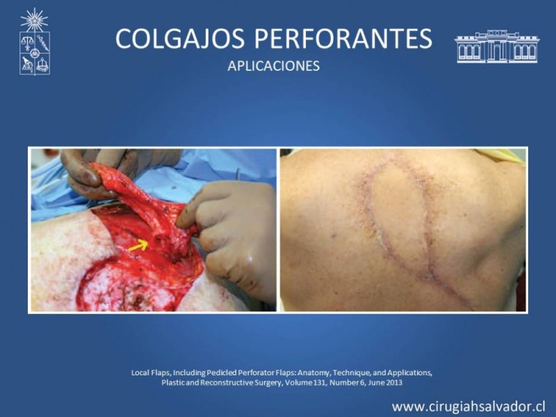 Diapositiva 47 de Aplicación Colgajos Perforantes