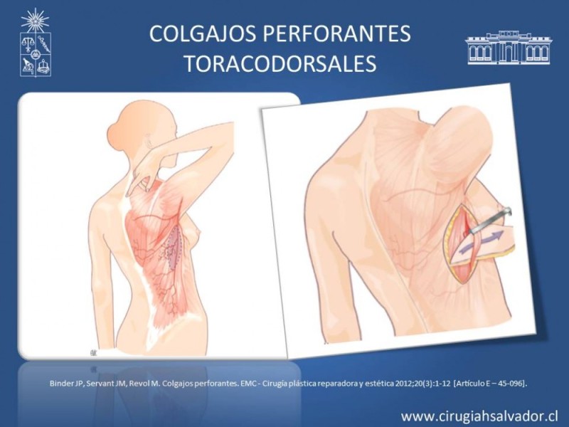 Diapositiva 27 de Aplicación Colgajos Perforantes