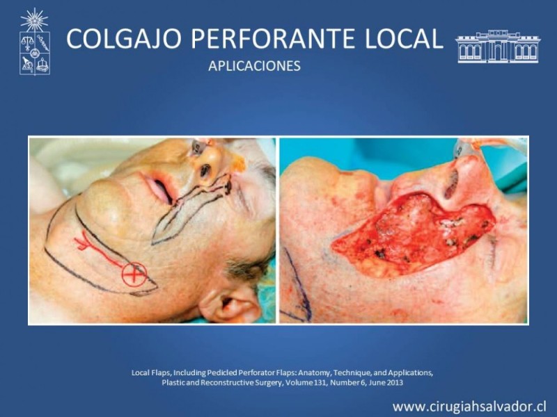 Diapositiva 23 de Aplicación Colgajos Perforantes