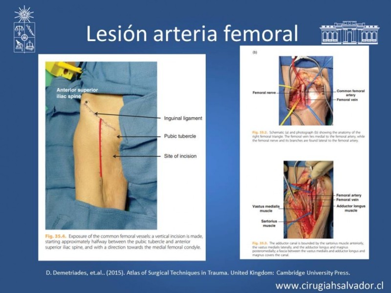 Diapositiva 31 de Trauma Vascular Periférico