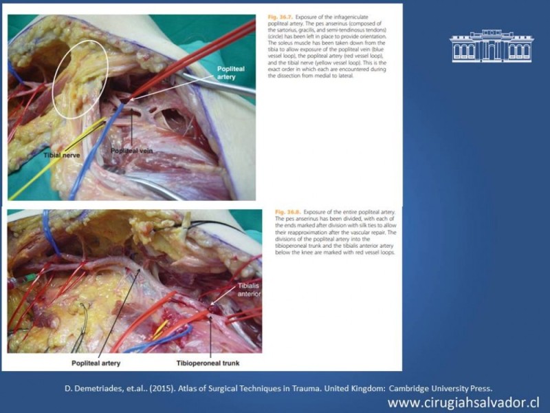 Diapositiva 35 de Trauma Vascular Periférico