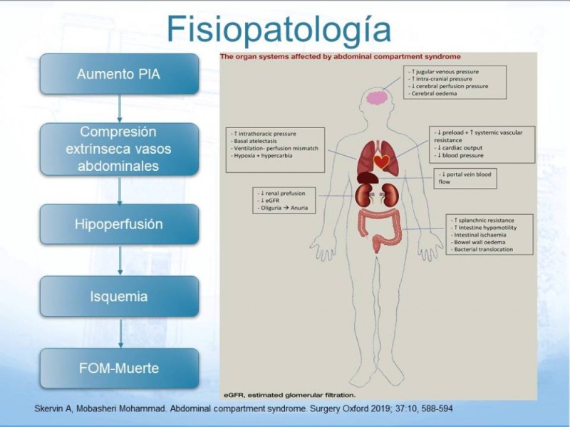 Diapositiva 4 de Síndrome Compartimental Abdominal