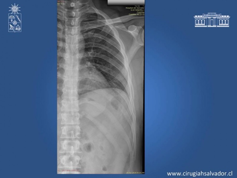 Diapositiva 10 de Trauma Esplénico