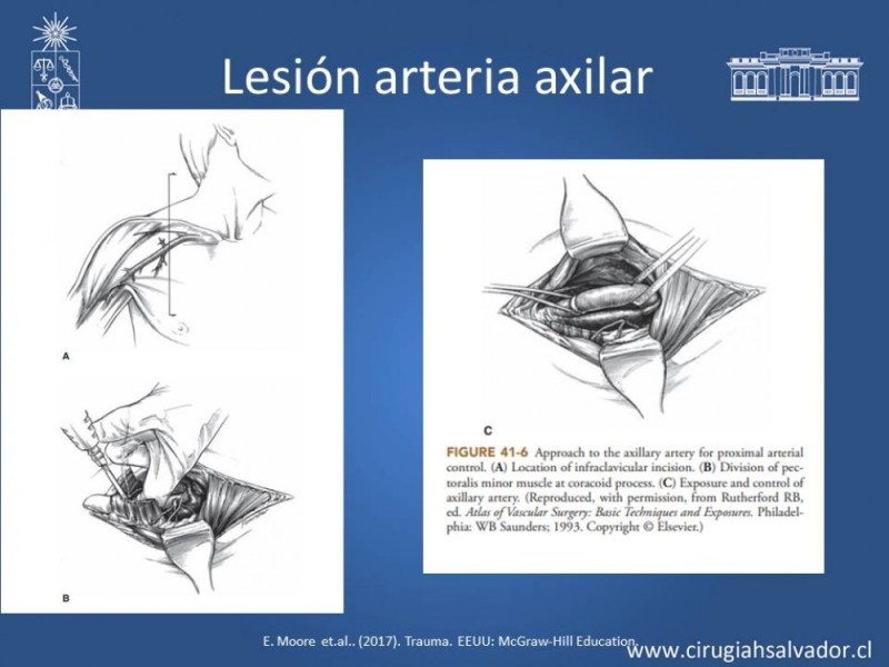 Diapositiva 25 de Trauma Vascular Periférico