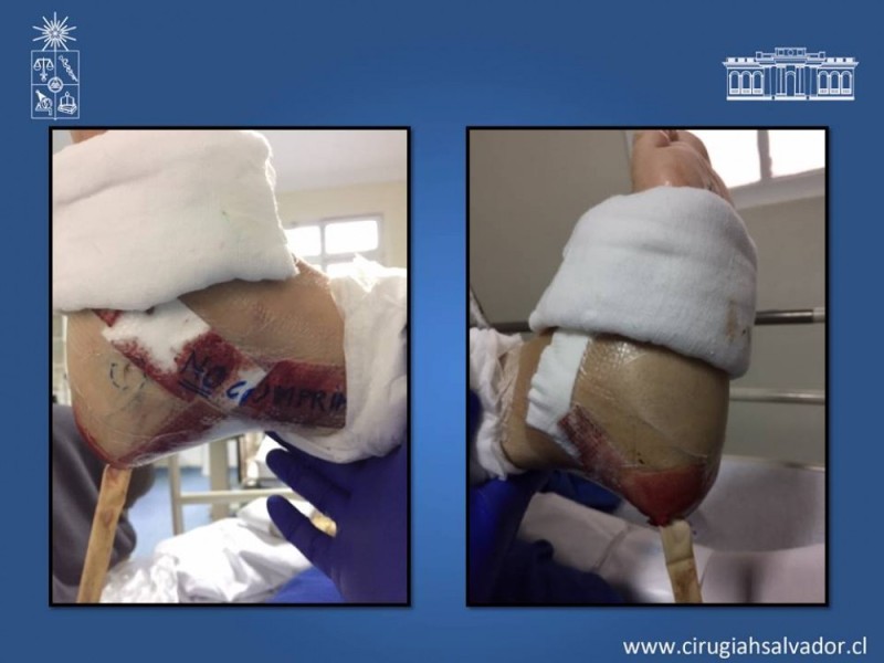 Diapositiva 52 de Aplicación Colgajos Perforantes
