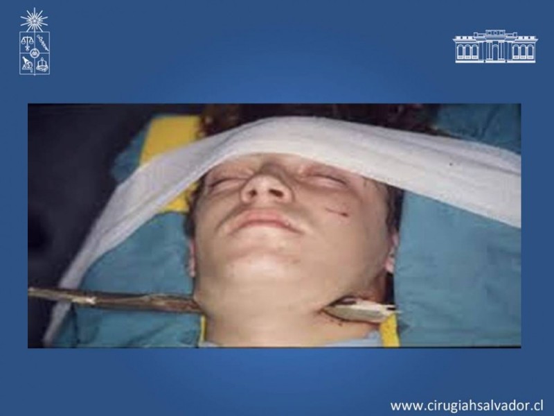 Diapositiva 47 de Trauma Carotídeo