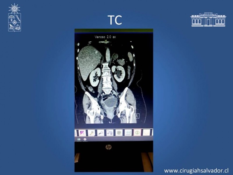 Diapositiva 10 de Absceso peri colónico