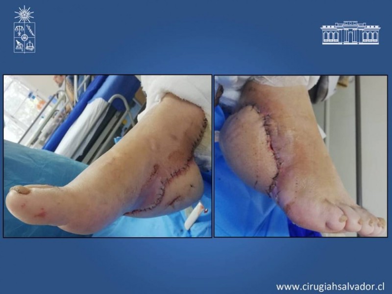 Diapositiva 53 de Aplicación Colgajos Perforantes