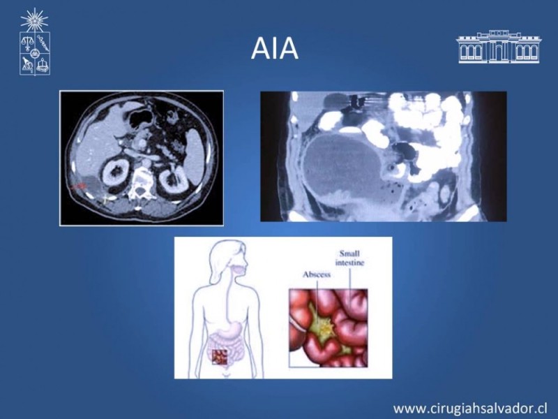 Diapositiva 28 de Absceso peri colónico