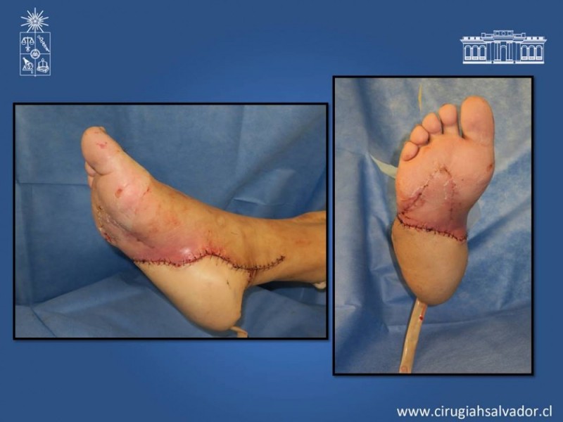 Diapositiva 51 de Aplicación Colgajos Perforantes