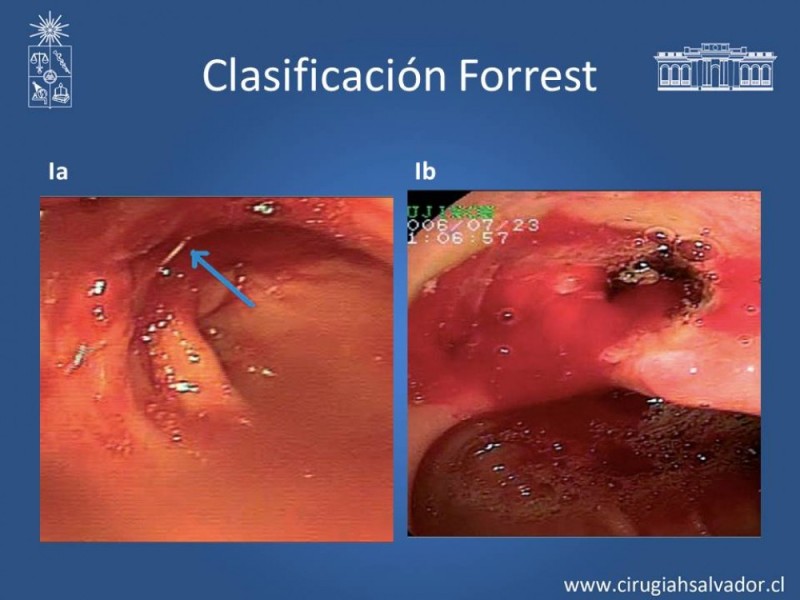 Diapositiva 25 de Hemorragia digestiva alta