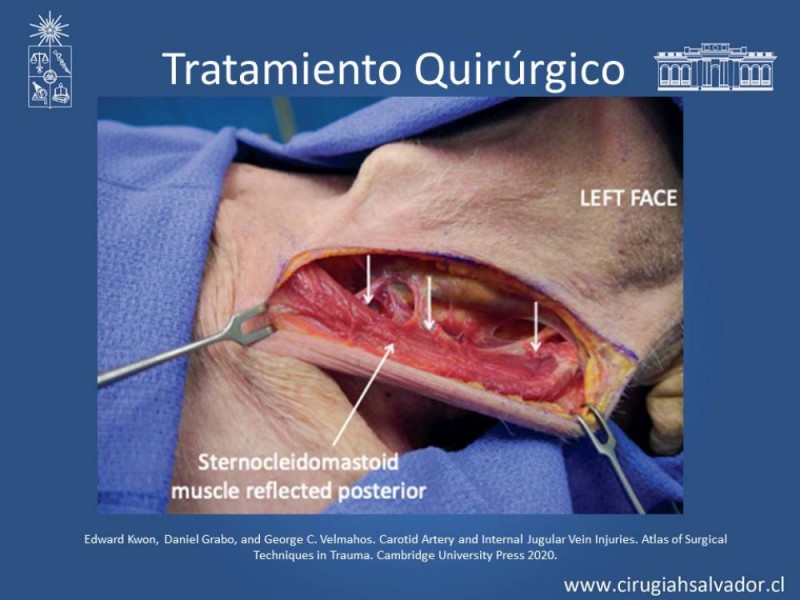 Diapositiva 33 de Trauma Carotídeo