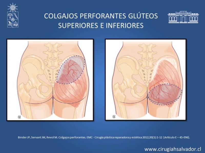 Diapositiva 29 de Aplicación Colgajos Perforantes
