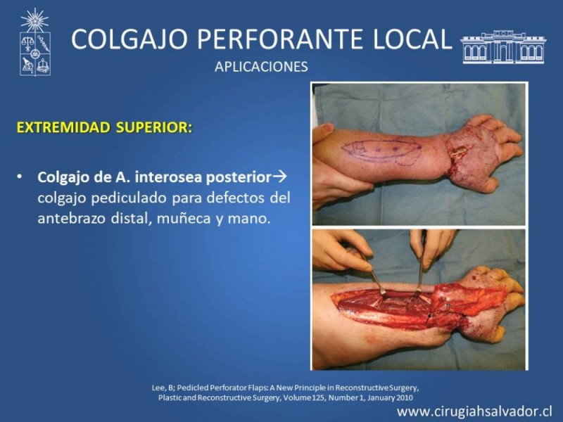 Diapositiva 25 de Aplicación Colgajos Perforantes