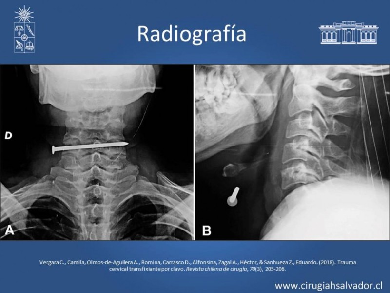 Diapositiva 17 de Trauma Carotídeo