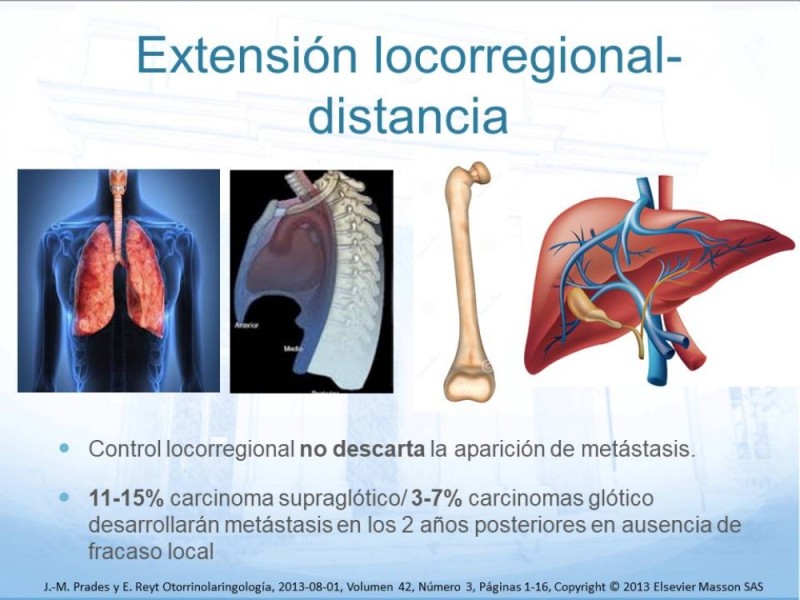 Diapositiva 9 de Cáncer Laringeo