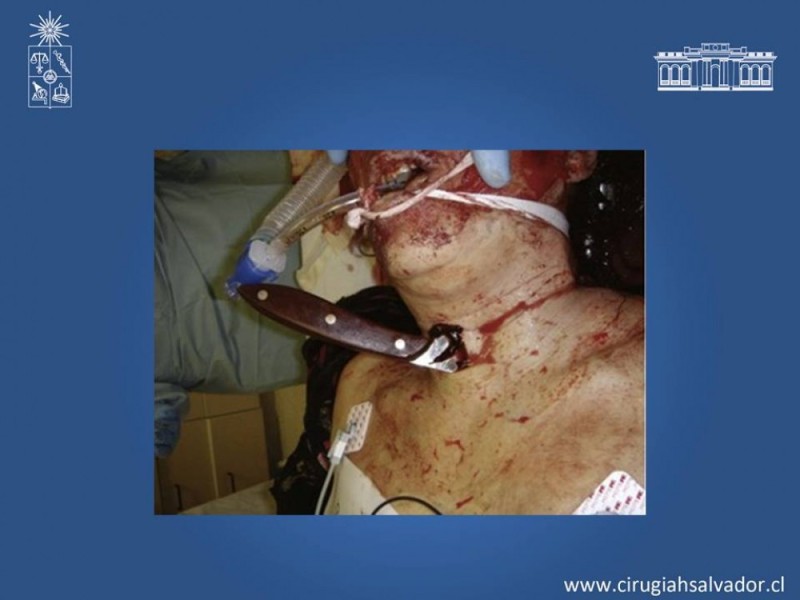 Diapositiva 48 de Trauma Carotídeo